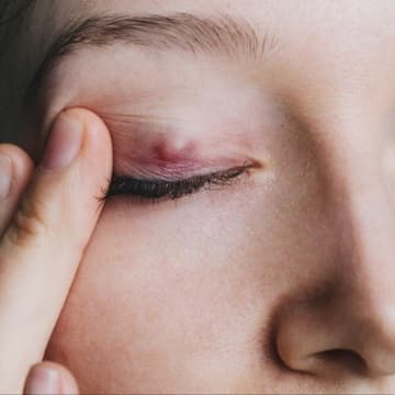 3 Sessions Chalazion IPL & LLLT at PRYSM LIGHT in West Burlington, IA