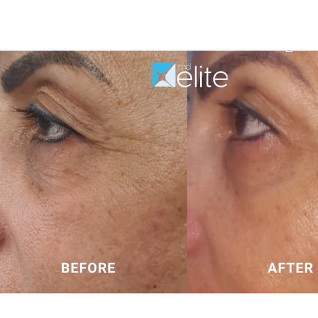 OcuLift at PRYSM LIGHT in West Burlington, IA