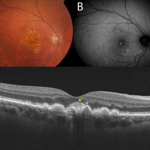 9 Session Macular Degeneration Tx at PRYSM LIGHT in West Burlington, IA