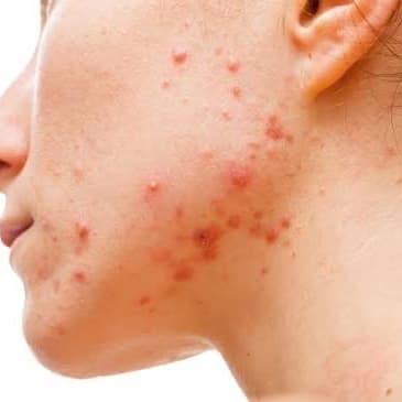 5 Session Acne Treatment Package at PRYSM LIGHT in West Burlington, IA