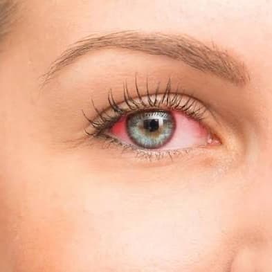 4 Session Dry Eye Treatment at PRYSM LIGHT in West Burlington, IA